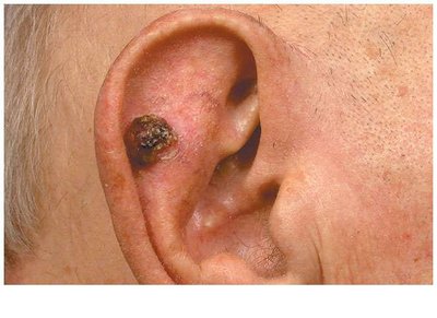 Squamous cell carcinoma