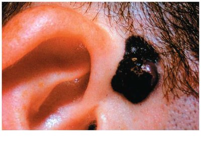 Malignant melanoma