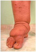 Lymphedema in the lower limb