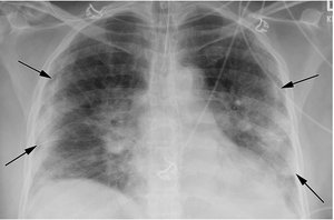Chest X-ray showing lung pathology