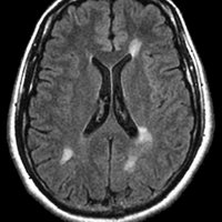 MRI scan of the brain