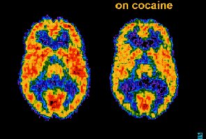 PET scan of brain showing normal and cocaine-affected activity