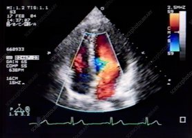 Color Doppler echocardiogram of the heart