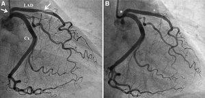 Coronary angiography before and after stent placement