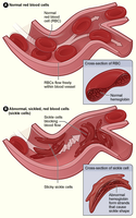 Normal vs. sickled red blood cells in blood vessels
