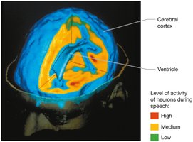 Functional neuroimaging (fMRI) of the brain during speech