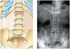 Compression fracture