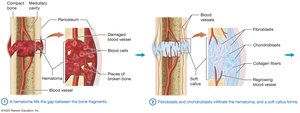 Hematoma and soft callus formation