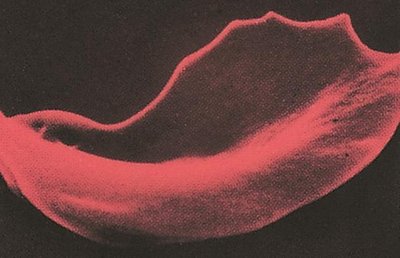Sickle-shaped red blood cell in sickle cell anemia