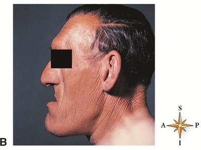 Acromegaly in an adult male