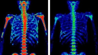 Medical imaging using radioisotopes
