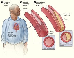 Diagram showing narrowing of coronary arteries in CAD