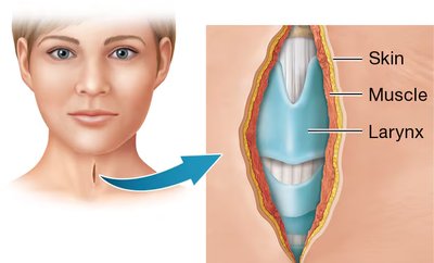 Surgical incision in the cervical region, showing skin, muscle, and larynx