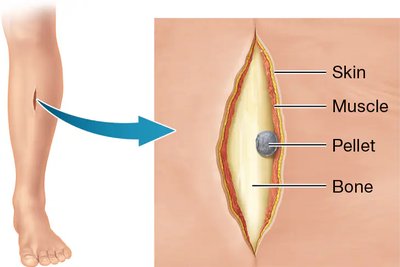 Pellet wound in the crural region, showing skin, muscle, pellet, and bone