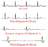 Normal and AV block ECG patterns