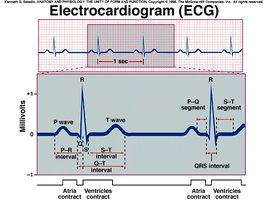 Electrocardiogram (ECG) with labeled waves