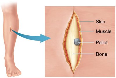 Wound in crural region