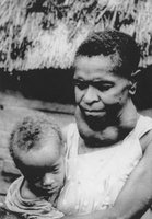 Child with congenital iodine deficiency syndrome