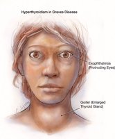 Grave's disease with exophthalmos and goiter