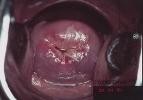 Photograph of the cervix as seen during a gynecological exam