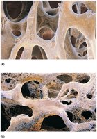 Normal bone vs. osteoporotic bone