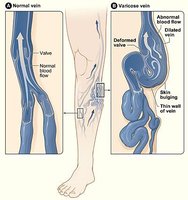 Normal vs. varicose veins