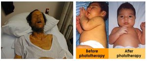Jaundice in adults and newborns before and after phototherapy