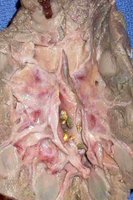 Kidney stones (renal calculi)