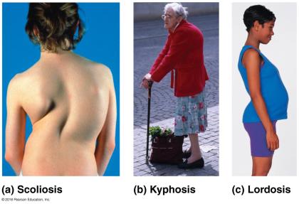 Examples of scoliosis, kyphosis, and lordosis