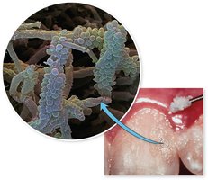 Plaque biofilm and tooth surface