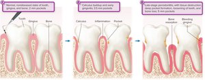 Stages in soft-tissue infection, gingivitis, and periodontitis