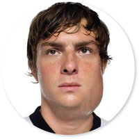 Mumps with parotid gland swelling