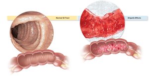 Normal and diseased large intestinal mucosa in Shigella dysentery