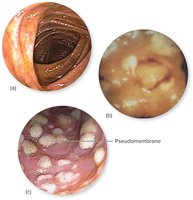 Healthy colon and pseudomembranous colitis caused by C. difficile