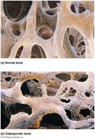 Normal vs osteoporotic bone