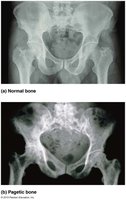 Normal vs Pagetic bone