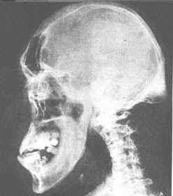Acromegaly x-ray