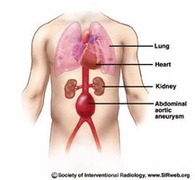 Abdominal aortic aneurysm