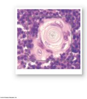 Thymic corpuscle in the thymus