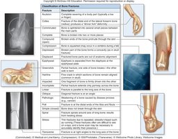 Classification of bone fractures