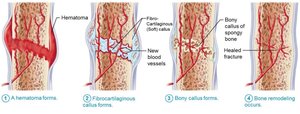 Steps of fracture healing