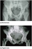Normal vs Pagetic bone
