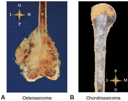 Osteosarcoma and chondrosarcoma images