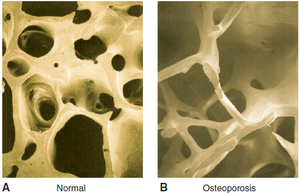 Comparison of normal and osteoporotic spongy bone