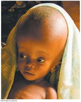 Clinical image of hydrocephalus