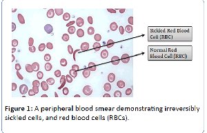 Peripheral blood smear showing sickled and normal red blood cells