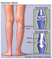 Diagram of normal and varicose veins