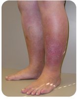 Edema (swelling) in the lower leg