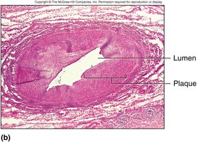 Histological section of artery with atherosclerotic plaque