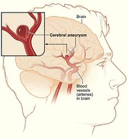 Cerebral aneurysm in the brain